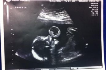 Когда УЗИ показало большой “пузырь” возле рта ребёнка, врачи сказали - сделать аборт. Но через 5 месяцев она удивила всех