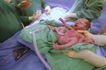 Мама ждала “нормальных” близнецов, но когда врачи показали ей это фото, у нее сорвало дыхание